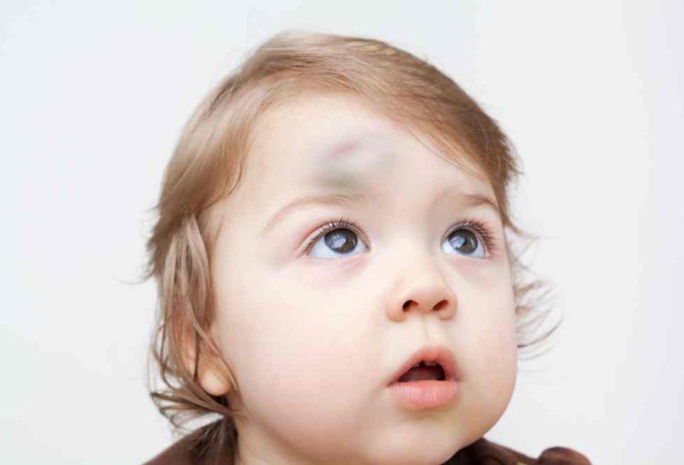 por qué mi hijo se golpea en la cabeza